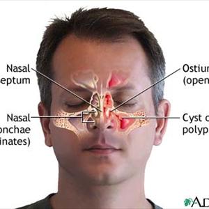 Sinusitis Garlic - Overuse Of Antibiotics For Children With Sinusitis