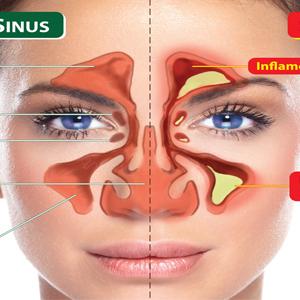 Cura Sinusitis - Severe Sinus Infection