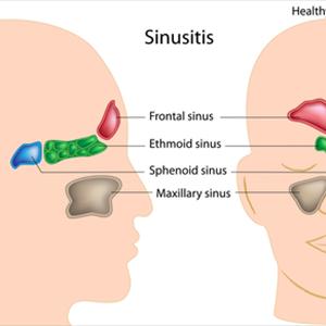 Sinus Nasal Congestion - The Facts About Sinusitis