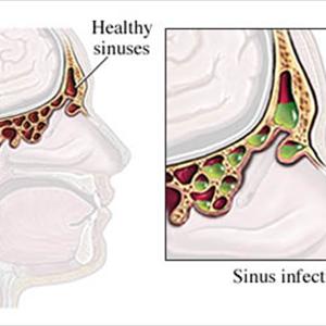 Ethmoid Sinus And Vision 