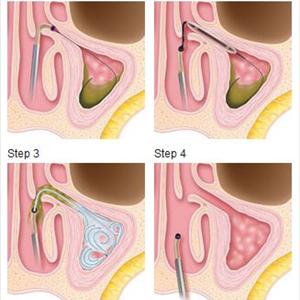 Sinus Cough - Acute Sinus Infection