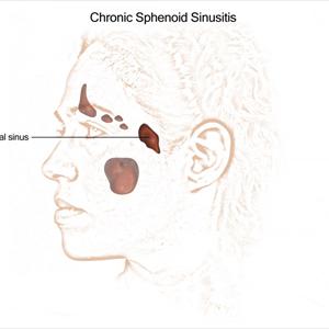 Sinusitis Description 