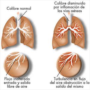 Relieving Sinus Pressure - How To Recognize Sinus Infection?