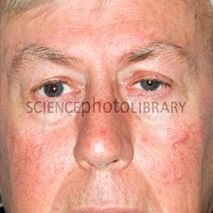 Sinusitis Origen - Treatment For Chronic Sinus Infection