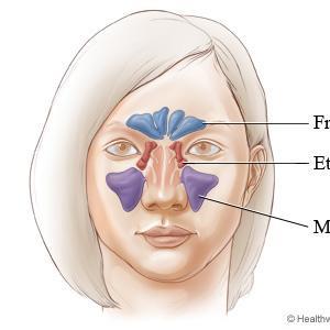 Penyakit Sinusitis - Nasal Congestion- The Role Of Humidity Control