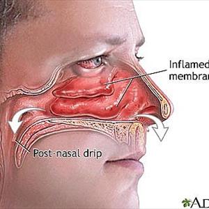 Of Sphenoid Sinus 