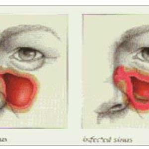 Symptoms Of Acute Sinuses 