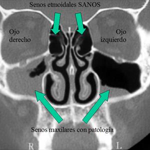 Sinusitis Soluciones 