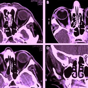 Nose Sinusitis - Sinusitis Discomfort