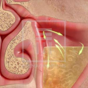 Sinuses Causes Dizziness - Treat Sinusitis With Horseradish Mixture