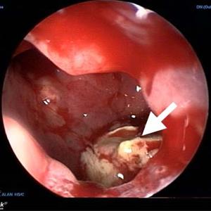 sinus infection antibiotics