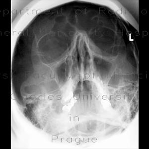 Clearing Out Sinus 