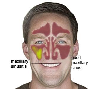 Deviated Septum Sinusitis - Where To Find A Best Natural Remedy That Work For Some Infection?