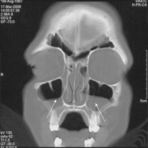 Sinusitis Earache - What Causes An Acute Sinus Infection Or Sinusitis? - Nurse