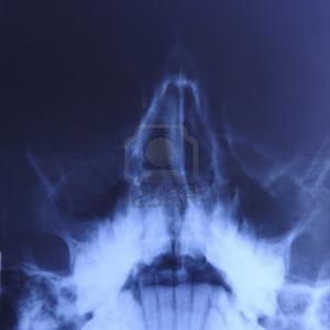 Paranasal Sinuses Nose - Sinus Infection