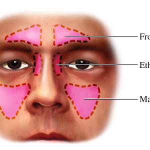 Sinusitis Tinnitus 