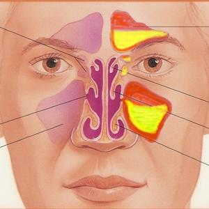 Intranasal Antibiotic Sinusitis - Natural Home Remedies For Sinus Infections - How To Get Better Without Any Side Effects