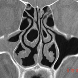 Strep Throat Sinusitis - Most Frequent Questions About Sinus Infections