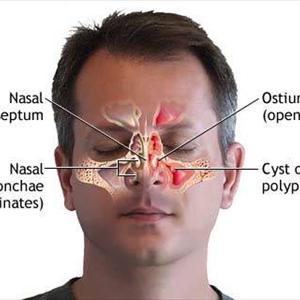 Cystic Fibrosis Sinusitis 