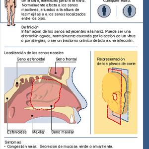 Chronic Sinusitis Specialists - Natural Cure For Sinus Infection - 12 Tips For Natural Cure Of Sinus Infection