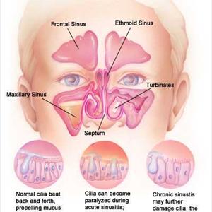 Dizziness Sinusitis Symptoms - How To Get Rid Of Sinus Headache?