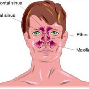 Definition Of Paranasal Sinuses - Sinusitis And Natural Supplements
