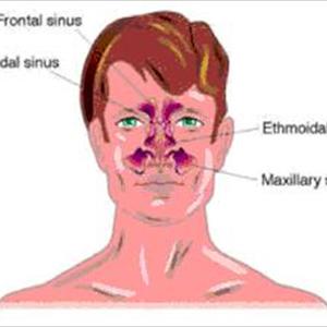 Etiologia Sinusitis - Laser Sinus Surgery