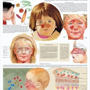 Ethmoid Sinuses Anatomy - Understanding What Is Sinus Disease