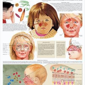 To Drain Maxillary Sinus - How To Get Rid Of A Sinus Infection?