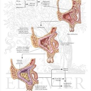 Sinusitis Problems - Understanding What Is Para Nasal Sinus Disease